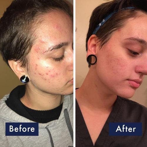 PanOxyl - Acne Foaming Wash (Original)